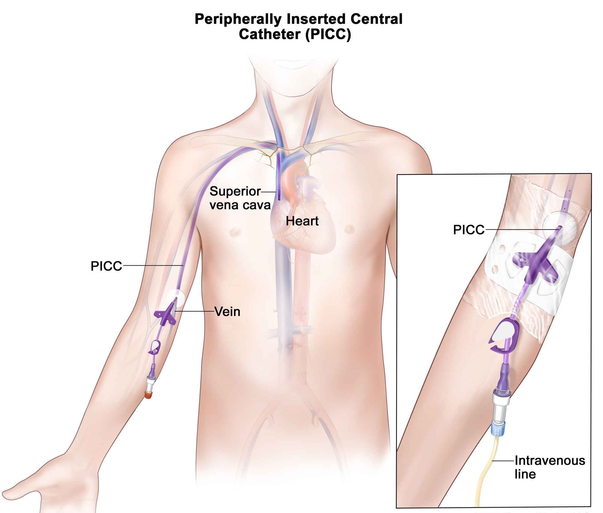 Hospitalist PICC article